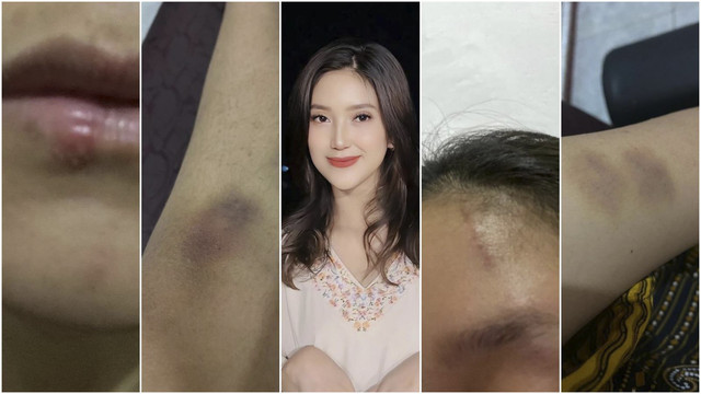 Adelia Septa Berani Bicara, Suami Terjerat Kasus KDRT